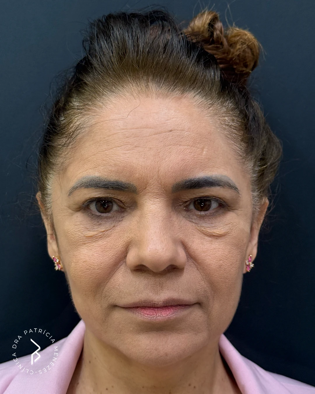 Full face — Antes