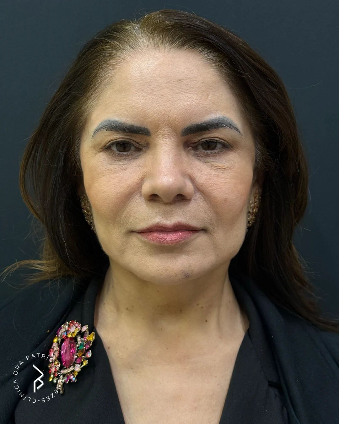 Full face — Depois