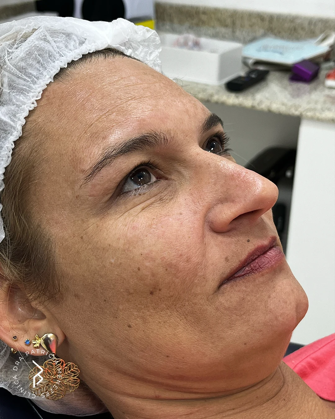 Preenchimento labial — Antes