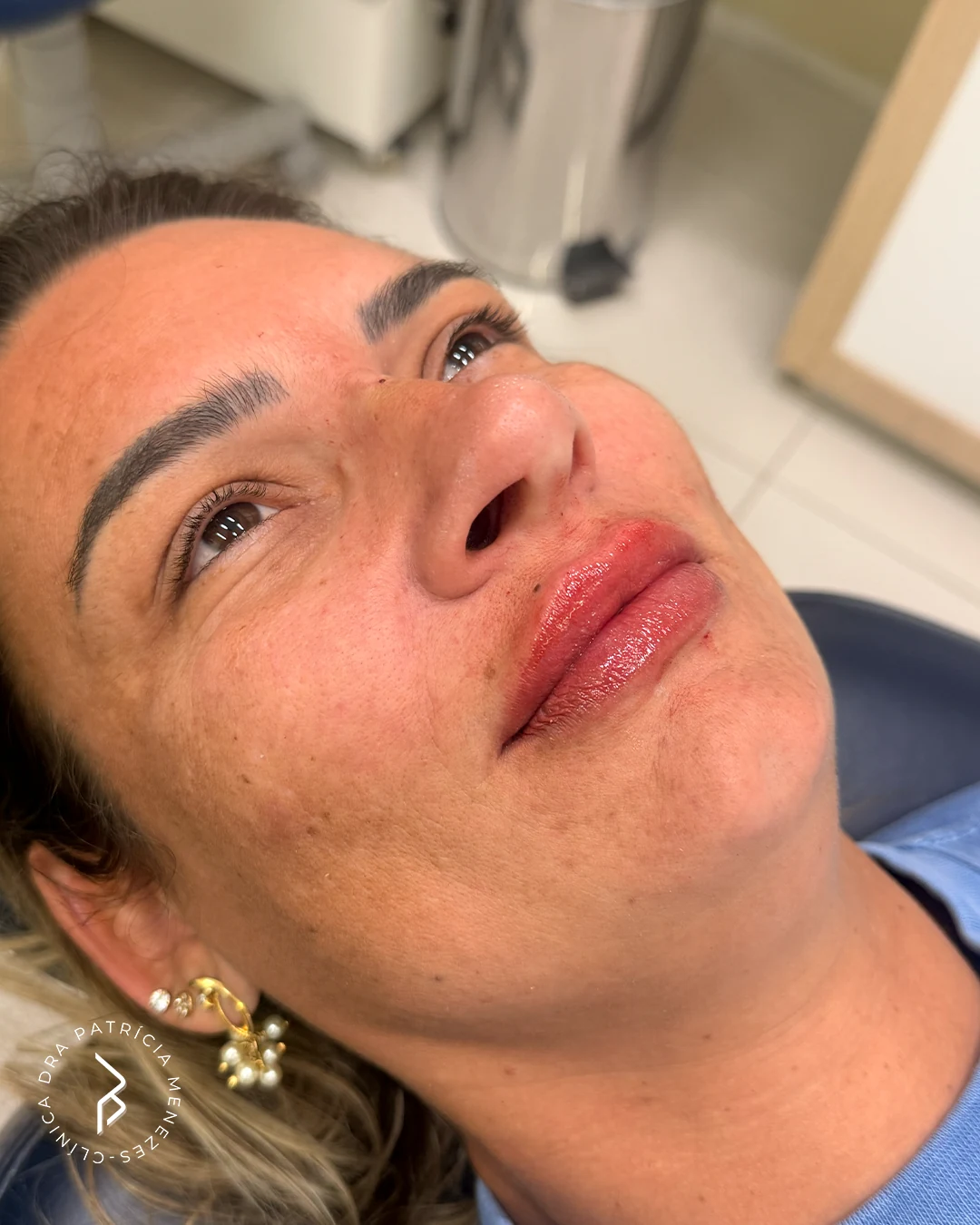 Preenchimento labial — Depois