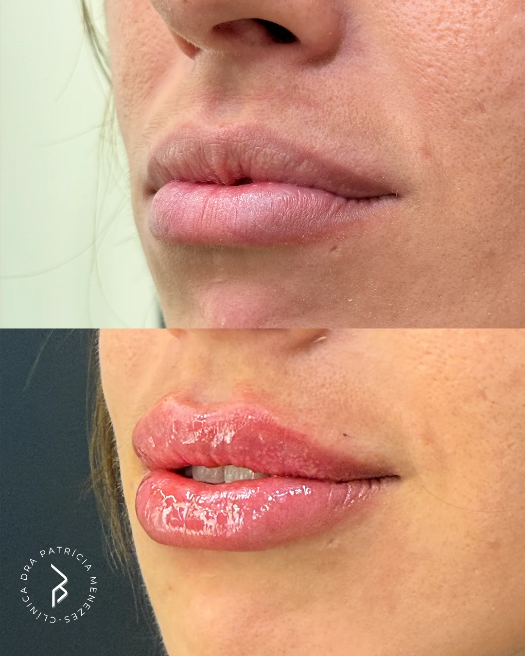 Antes e depois de Caso 01 — preenchimento labial