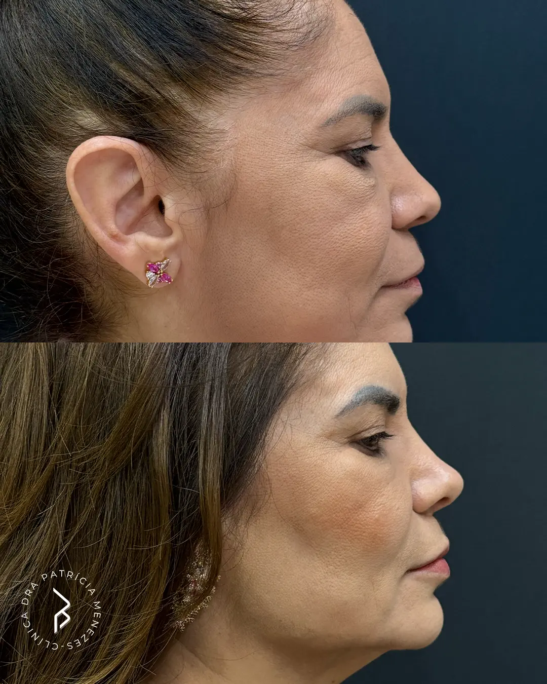Antes e depois de Caso 01 — rinomodelação
